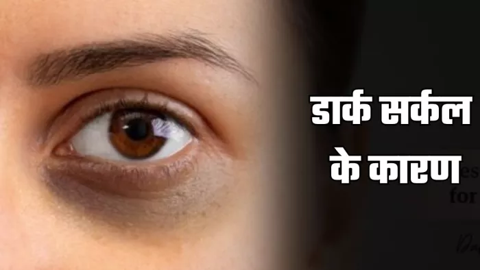 क्यों होते हैं डार्क सर्कल? (Image Credit- Freepik)