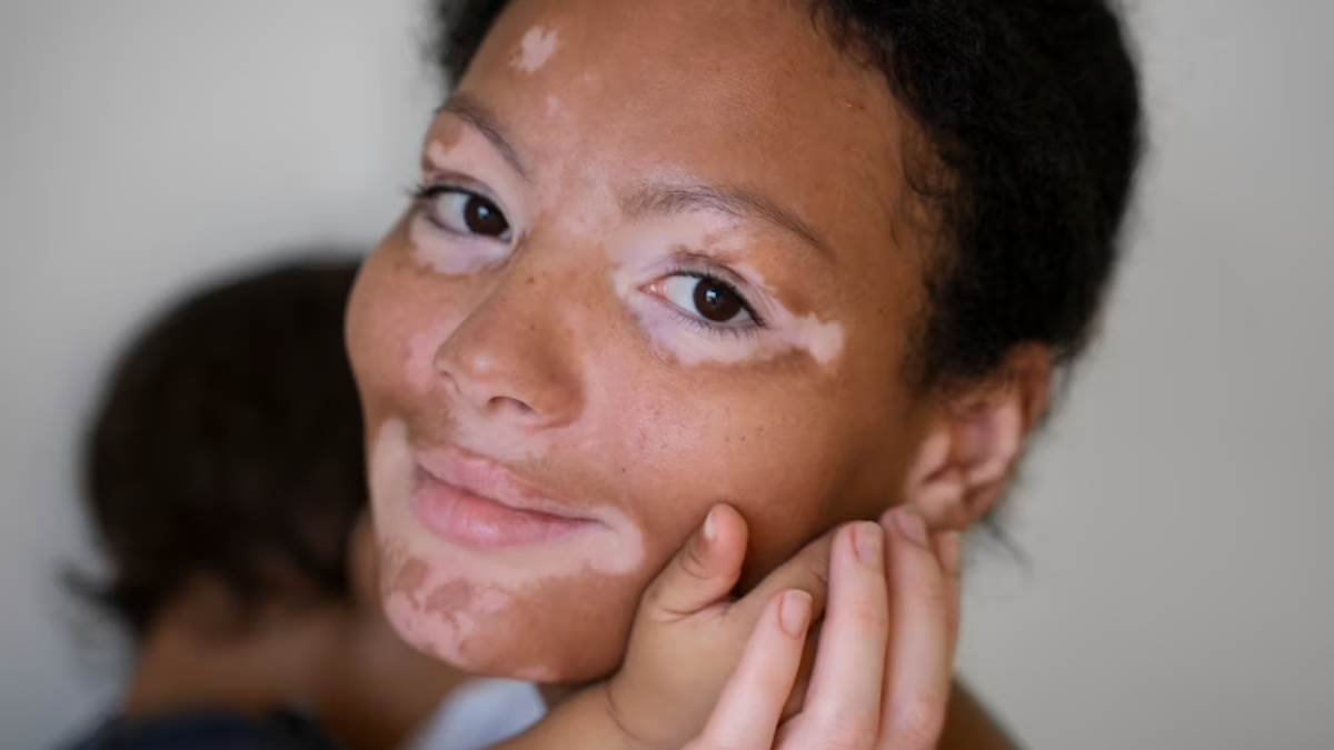 what is vitiligo its symptoms and causes why world vitiligo day celebrated