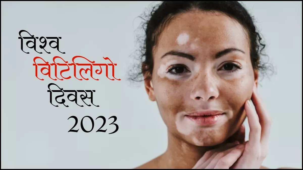 World Vitiligo Day 2023 कैसे हुई विश्व विटिलिगो दिवस की शुरुआत, जानें