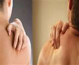 एंटीबायोटिक में दिखी स्किन कैंसर के उपचार की उम्मीद, पढ़ें- अध्ययन में सामने आइ बातें