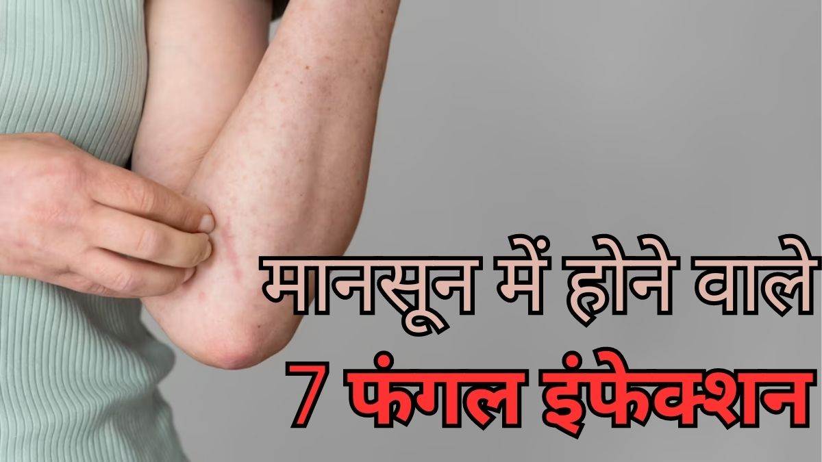 फंगल इंफेक्शन होने पर क्या खाना चाहिए और क्या नहीं? जानें एक्सपर्ट से | fungal  infection diet dos and donts in hindi | OnlyMyHealth