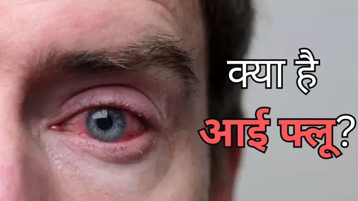 मानसून में तेजी से फैल रहा आई फ्लू, इन तरीकों से रखें अपना ध्यान