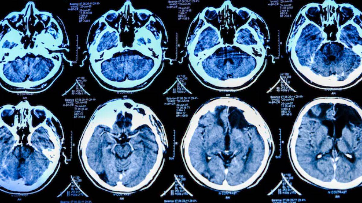 https://www.jagranimages.com/images/newimg/24072025/24_07_2025-brain_ageing_after_covid_19_23992712.jpg
