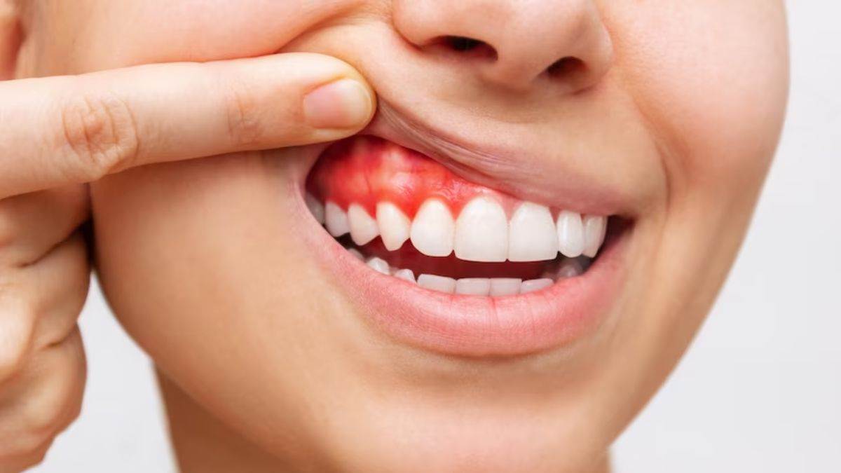 https://www.jagranimages.com/images/newimg/24082023/24_08_2023-gum_care_tips_23510813.jpg