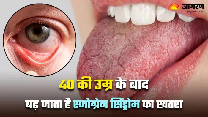 Sjogren's Syndrome में हो जाती है आंख और मुंह में सूखेपन की तकलीफ (Image Source: Freepik)