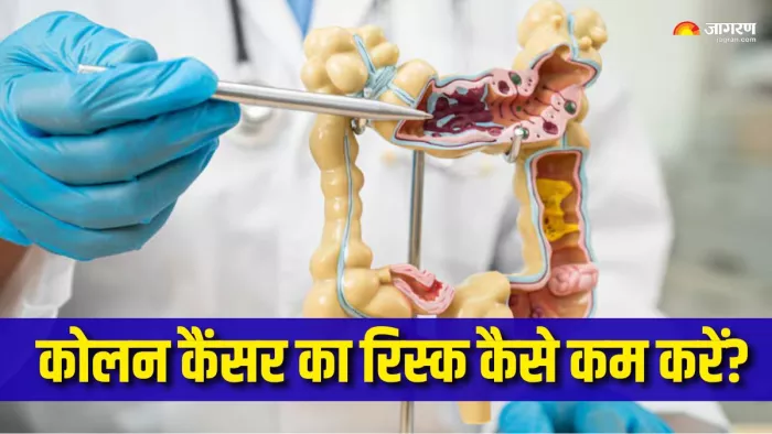 कोलन कैंसर से बचाव के लिए क्या करना चाहिए? (Picture Courtesy: Freepik)
