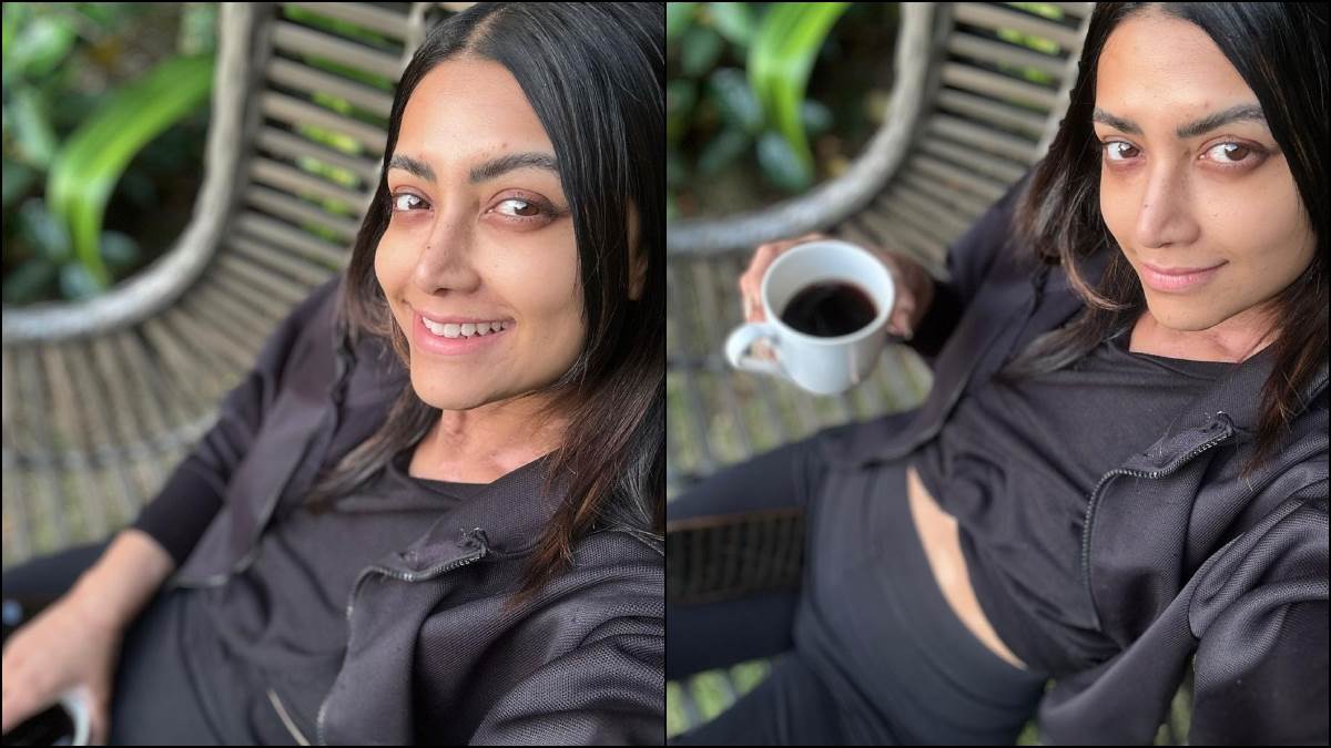 what is vitiligo south actress mamta mohandas diagnosed with vitiligo know about its symptoms and causes