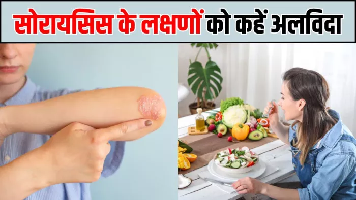 सोरायसिस को मैनेज करने में मदद करेगा यह डाइट प्लान (Image Source: Freepik)