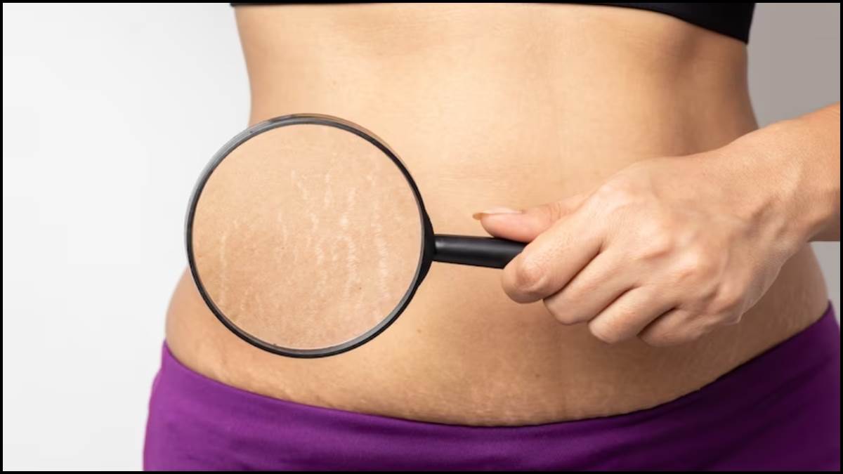https://www.jagranimages.com/images/newimg/25042023/25_04_2023-stretch-marks_23395058.jpg