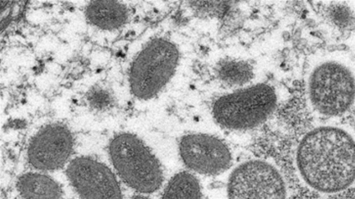 इलेक्ट्रान माइक्रोस्‍कोप में मंकीपाक्स वायरस कण (REUTERS)