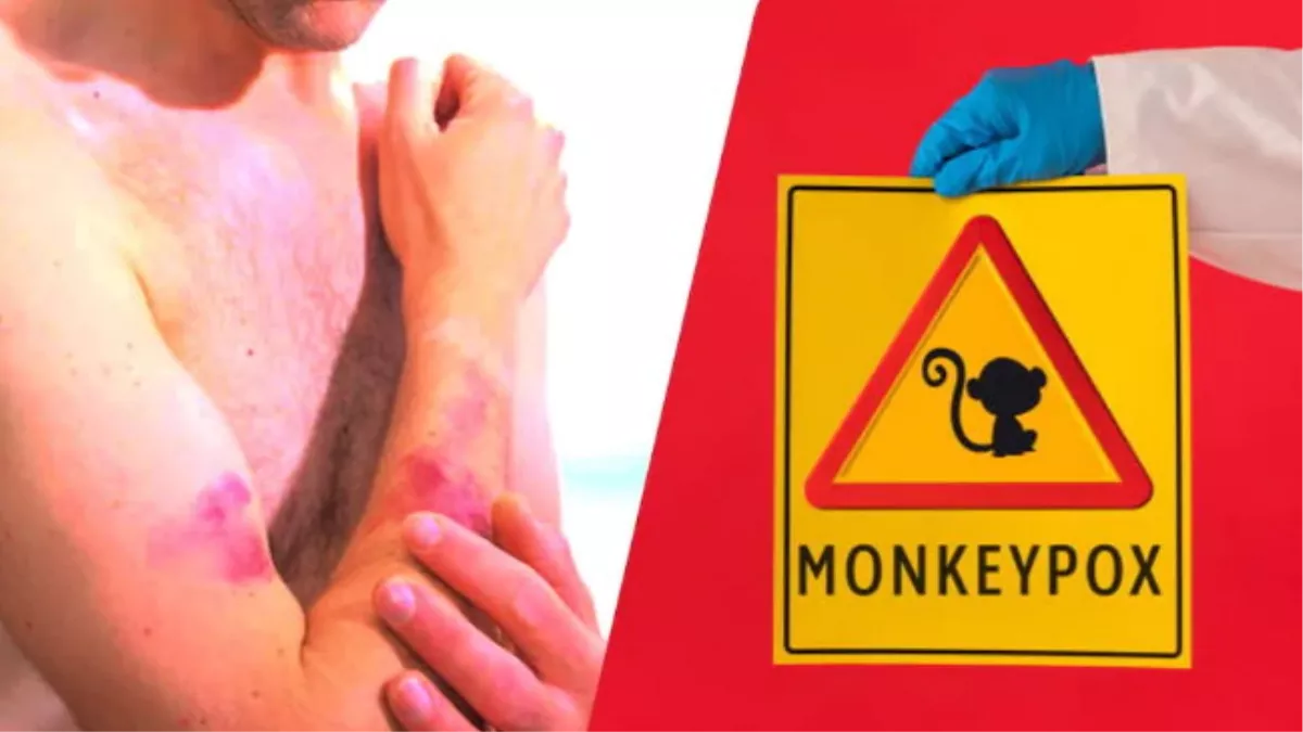 Monkeypox: विदेशों में फैला मंकी पाक्स, हरियाणा में अलर्ट, ऐसे बरतें सावधानी