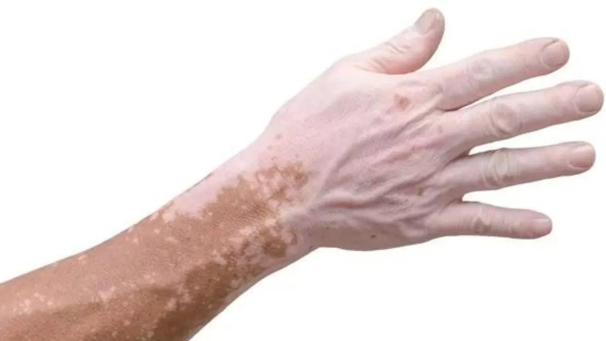 World Vitiligo Day 2022: सफेद दाग नहीं है छूआछूत की बीमारी... विशेषज्ञ ने बताया कैसे किया जा सकता इसका इलाज