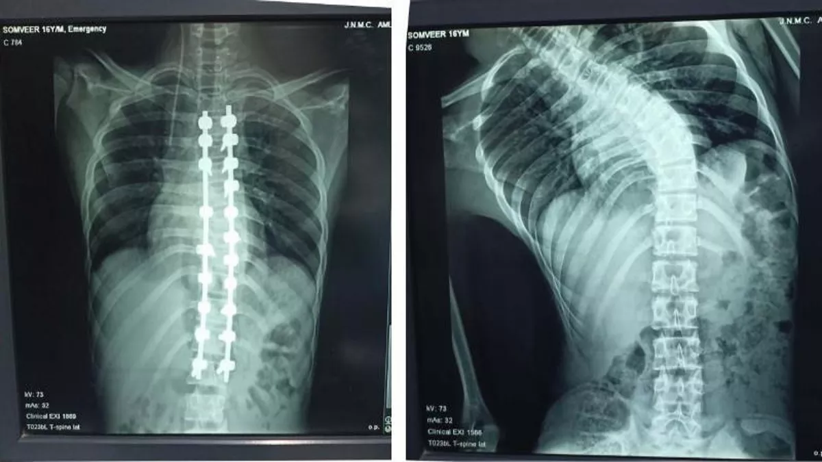 AMU News: आठ घंटे की सर्जरी के बाद एएमयू के डाक्‍टरों ने दुर्लभ सर्जरी कर टेढ़ी रीढ़ की हड्डी को कर दिया सीधा, क्‍या थी तकनीक,पढ़ें विस्‍तृत खबर