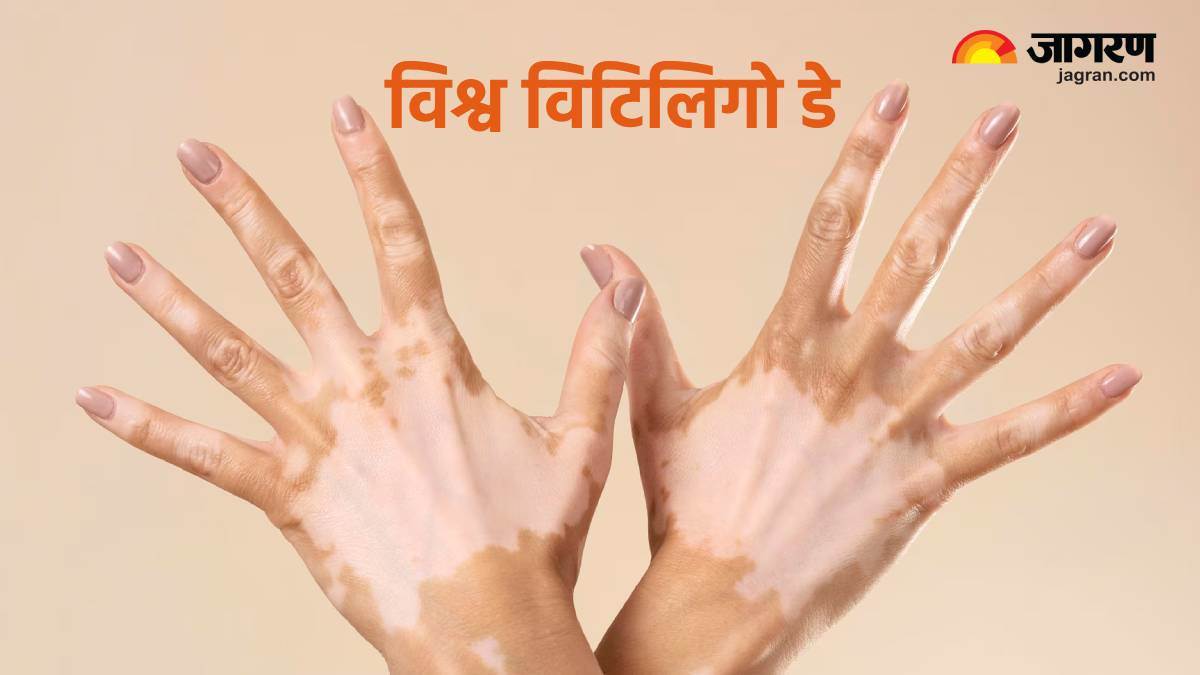 world vitiligo day 2024 history and significance behind this day