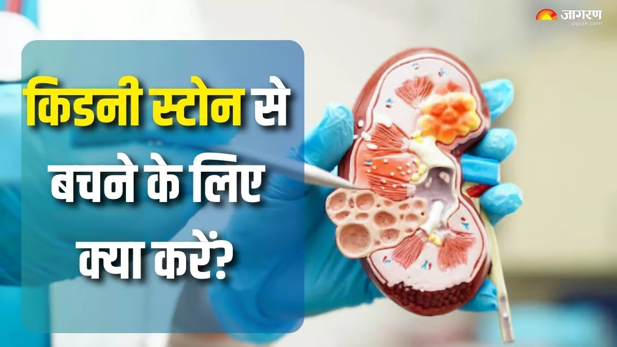 किडनी को धीरे-धीरे डैमेज करने लगती है पथरी की समस्या, बचाव के लिए ध्यान में रखें ये 5 बातें