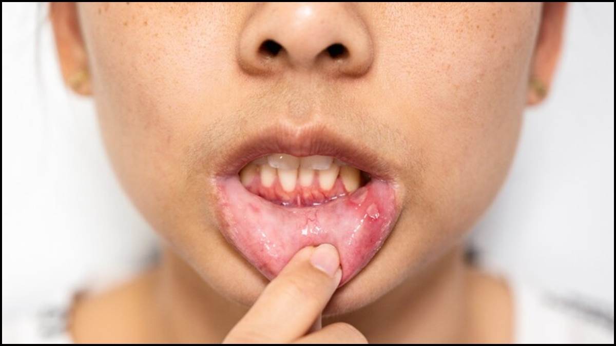 https://www.jagranimages.com/images/newimg/26012023/26_01_2023-ulcer_23309720.jpg