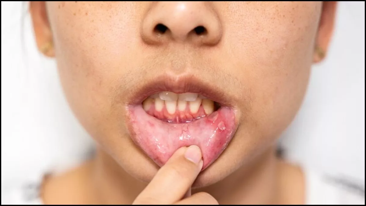 Mouth Ulcers Remedies: मुंह के छालों ने मुश्किल कर दिया है खाना-पीना, तो इन 5 घरेलू उपायों से पाएं राहत