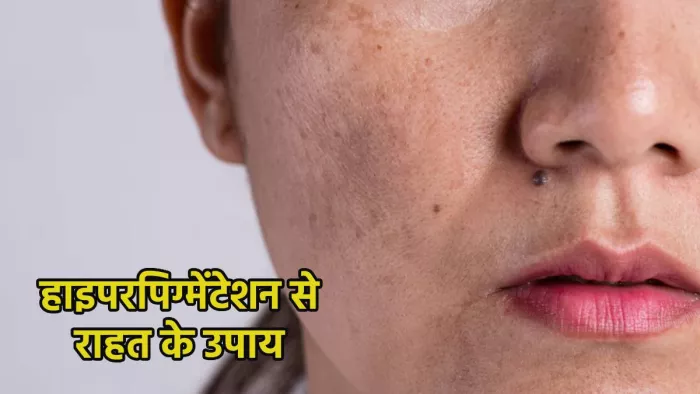 हाइपरपिग्मेंटेशन की प्रॉब्लम दूर करने के लिए ऐसे करें शहद का इस्तेमाल