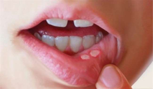 Mouth Ulcers Care: मुंह के छालों ने बेचैन कर दिया है तो इस तरह करें घर में  छालों का उपचार - Are you facing mouth ulcers Use these home remedies