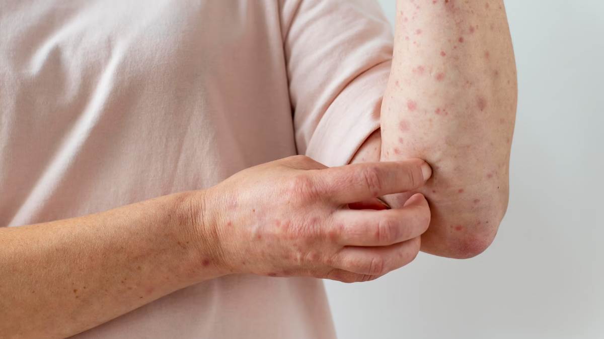 https://www.jagranimages.com/images/newimg/26042023/26_04_2023-shingles_disease_f_23395635.jpg