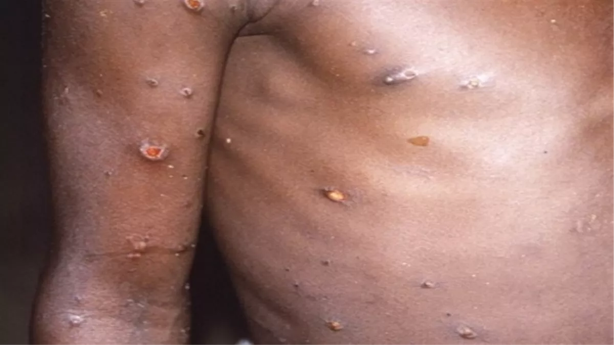 Monkeypox Virus: मंकीपाक्स को लेकर केंद्रीय स्वास्थ्य मंत्रालय जल्द जारी करेगा दिशानिर्देश