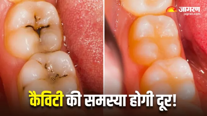 दांतों की कैविटी से छुटकारा दिलाएंगे 5 घरेलू नुस्खे (Image Source: Freepik)