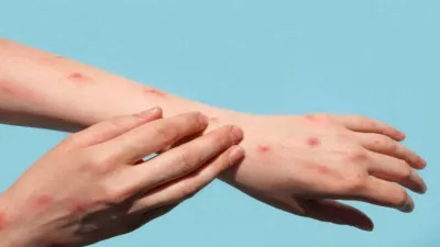 https://www.jagranimages.com/images/newimg/26072022/26_07_2022-monkeypox_22925705_14281948.jpeg