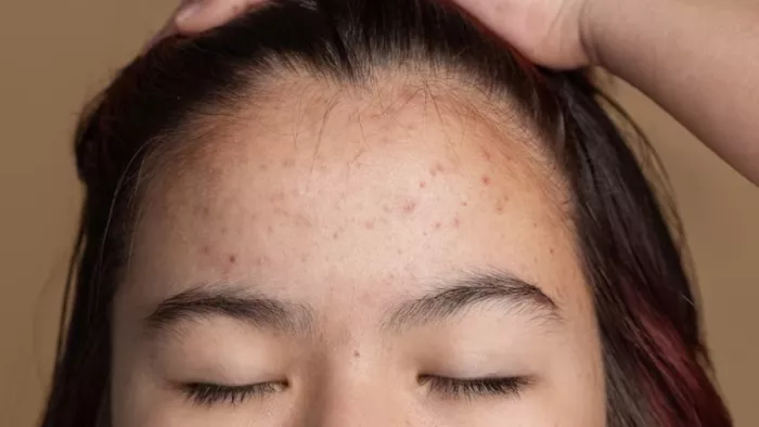 Blackheads Removal Tips: माथे के ब्लैकहेड्स दूर करने के उपाय