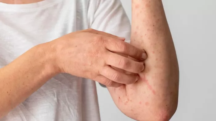 Monsoon Skin Care Tips: बारिश के मौसम में इस तरह रखें अपने त्वचा का ख्याल