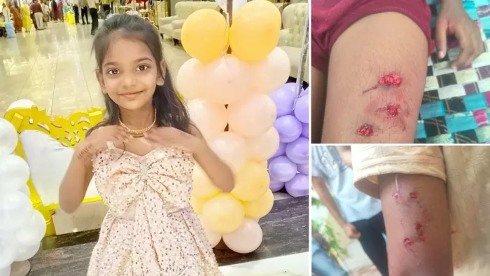 30 जून को बच्ची को एक आवारा कुत्ते ने हाथ और पैर में चार जगहों पर काट लिया था।