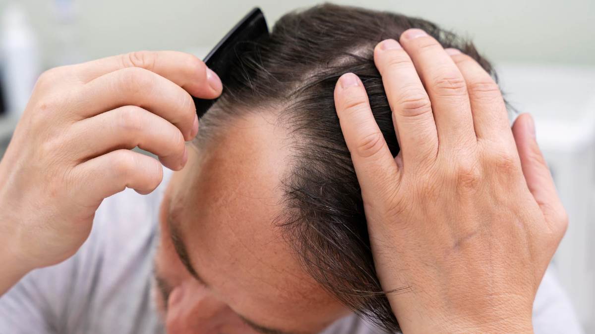 https://www.jagranimages.com/images/newimg/26112022/26_11_2022-alopecia_areata_f_23227169.jpg