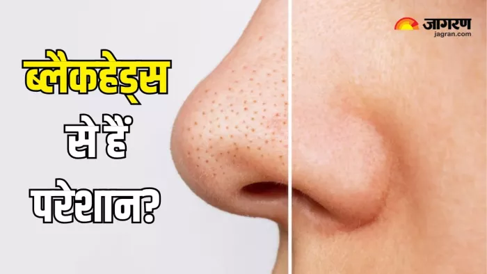 Blackheads रिमूव करने के लिए अपनाएं ये आसान टिप्स (Picture Courtesy: Freepik)