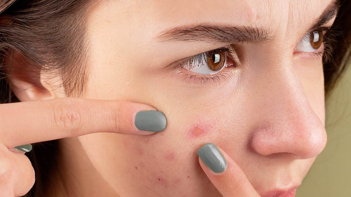 Skin Care Products For Acne: सालों से चेहरे के कील-मुंहासे ख़त्म होने का नहीं ले रहे नाम? अब दिखेगा गज़ब का कमाल