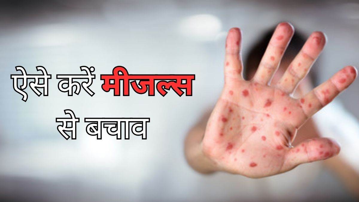 https://www.jagranimages.com/images/newimg/27022024/27_02_2024-measles_3_23662511.jpg