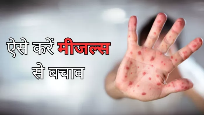 इन तरीकों से रखें अपने बच्चों को मीजल्स से सुरक्षित