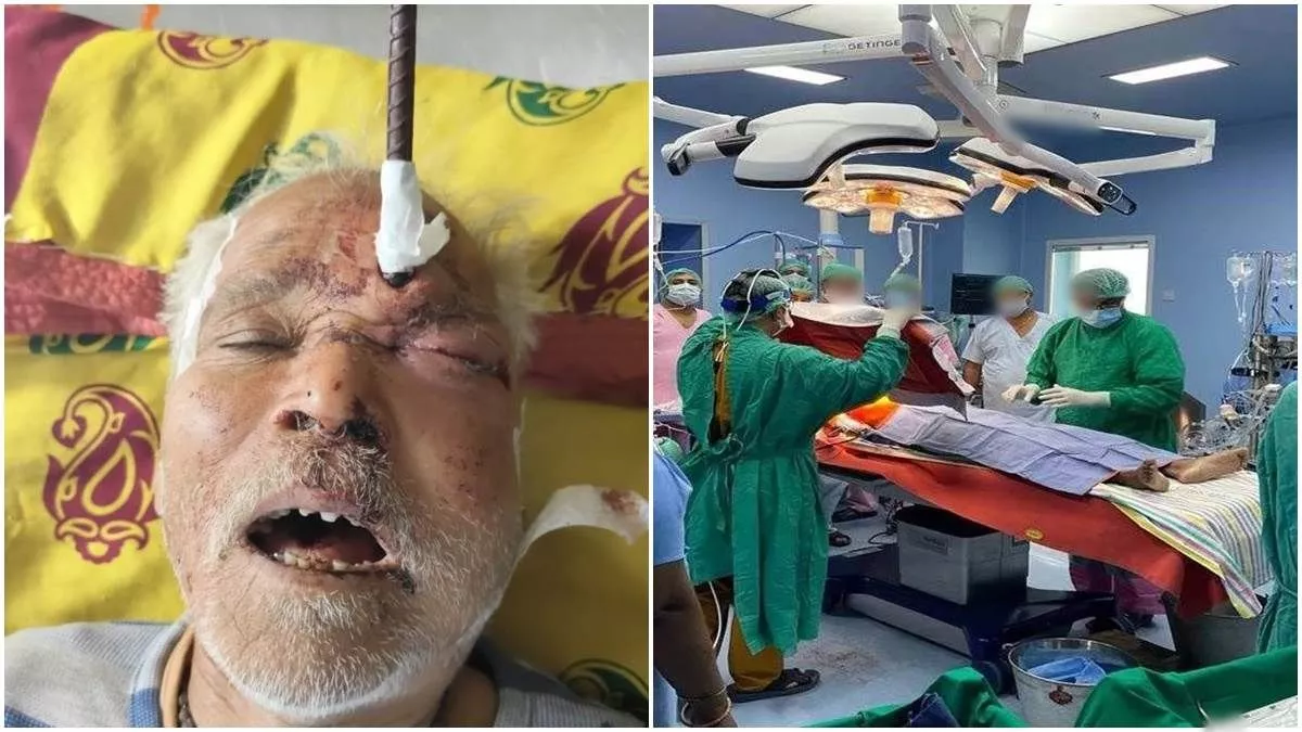 Jabalpur: निर्माणाधीन मकान में गिरा 80 वर्षीय बुजुर्ग, सिर में 15 सेमी अंदर घुसा सरिया; इस तरह सर्जरी कर बचाई जान
