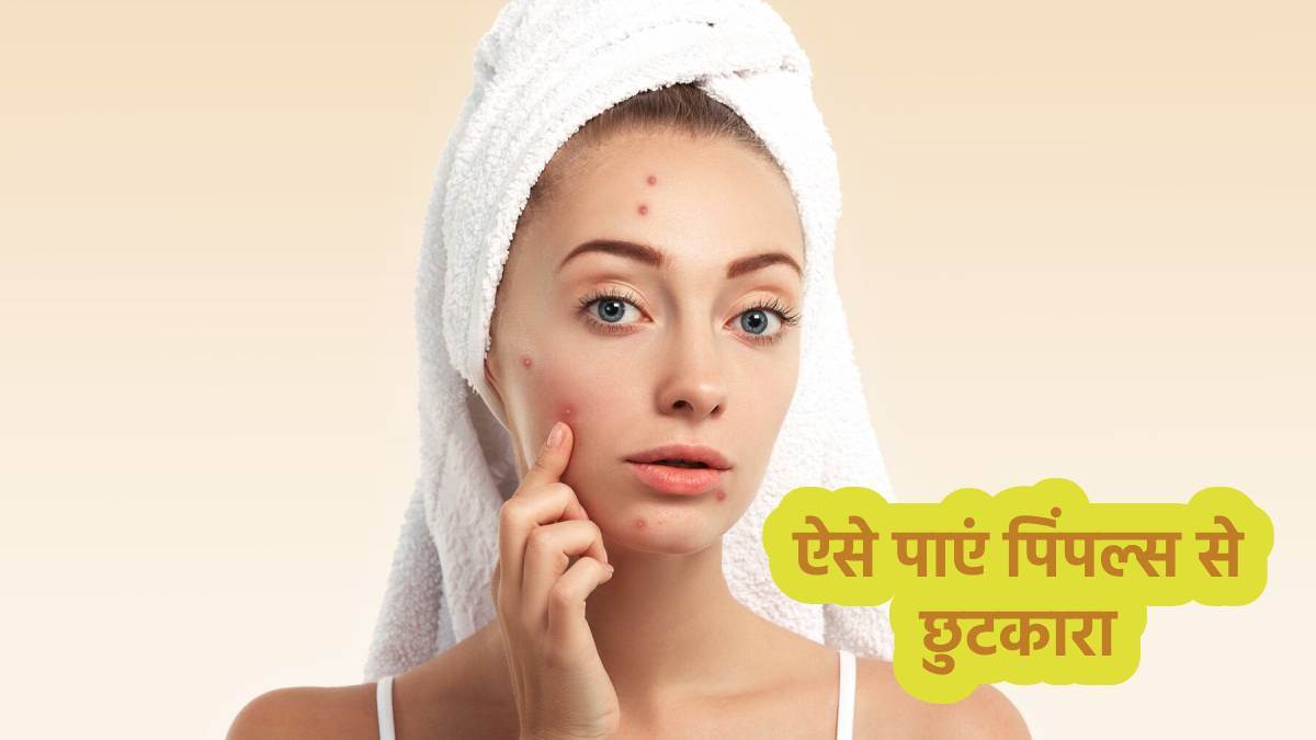 https://www.jagranimages.com/images/newimg/27032024/27_03_2024-ayurvedic_remedies_for_pimples_23683570.jpg