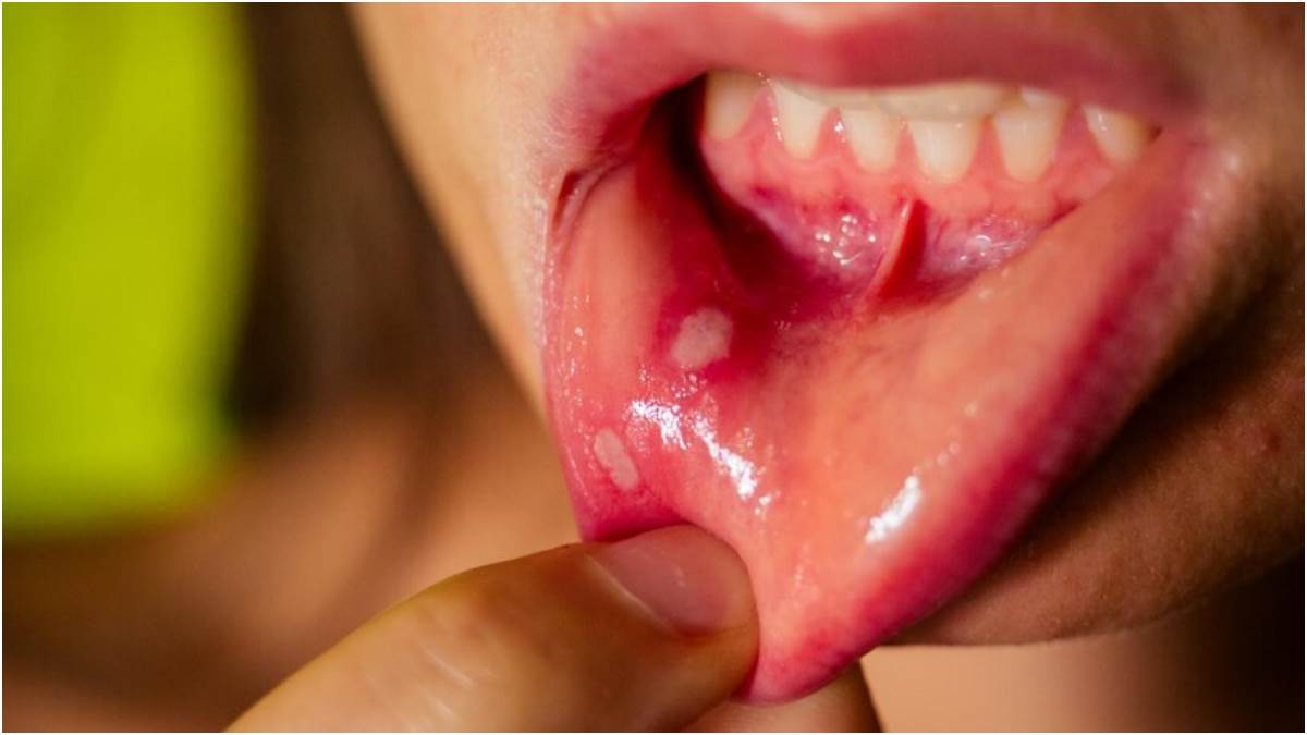 https://www.jagranimages.com/images/newimg/27042023/27_04_2023-mouth-ulcers-remedies_23397018.jpg