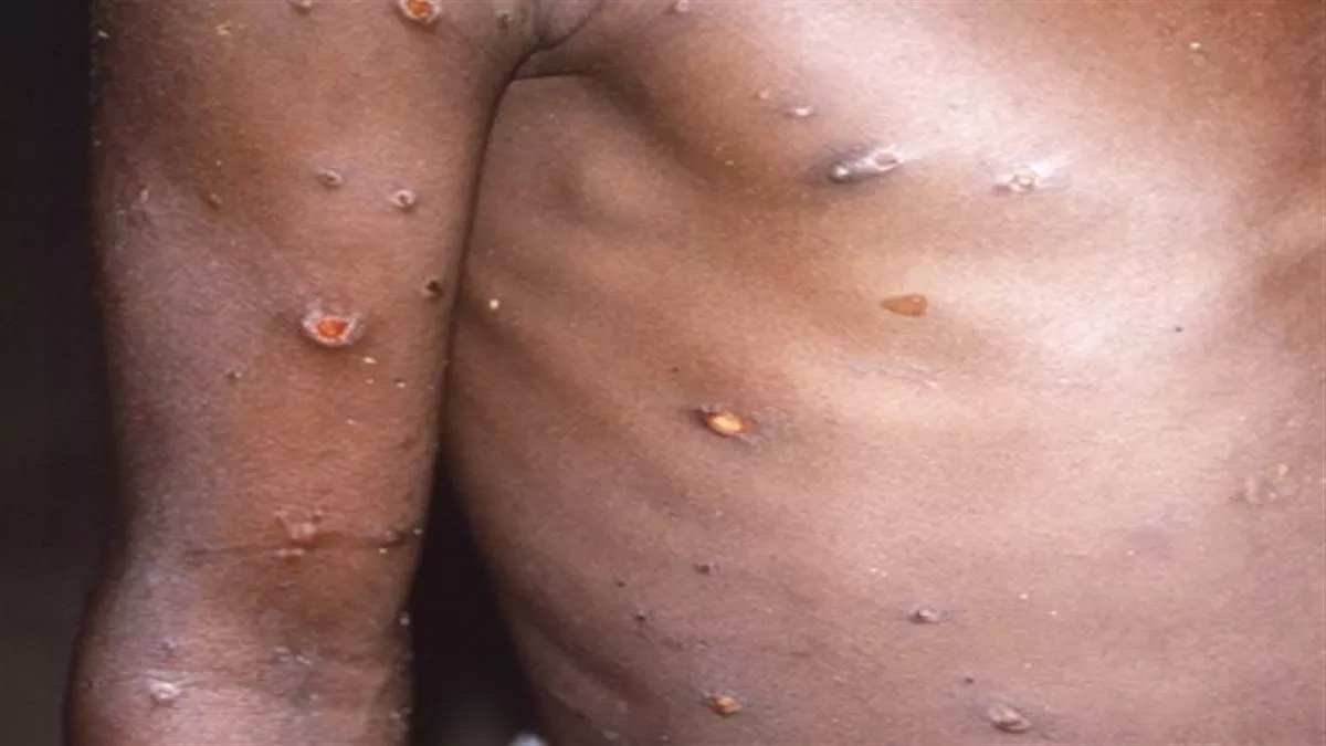 Monkeypox Virus: खतरनाक है मंकीपाक्स, जाने बचाव व इलाज के तरीके