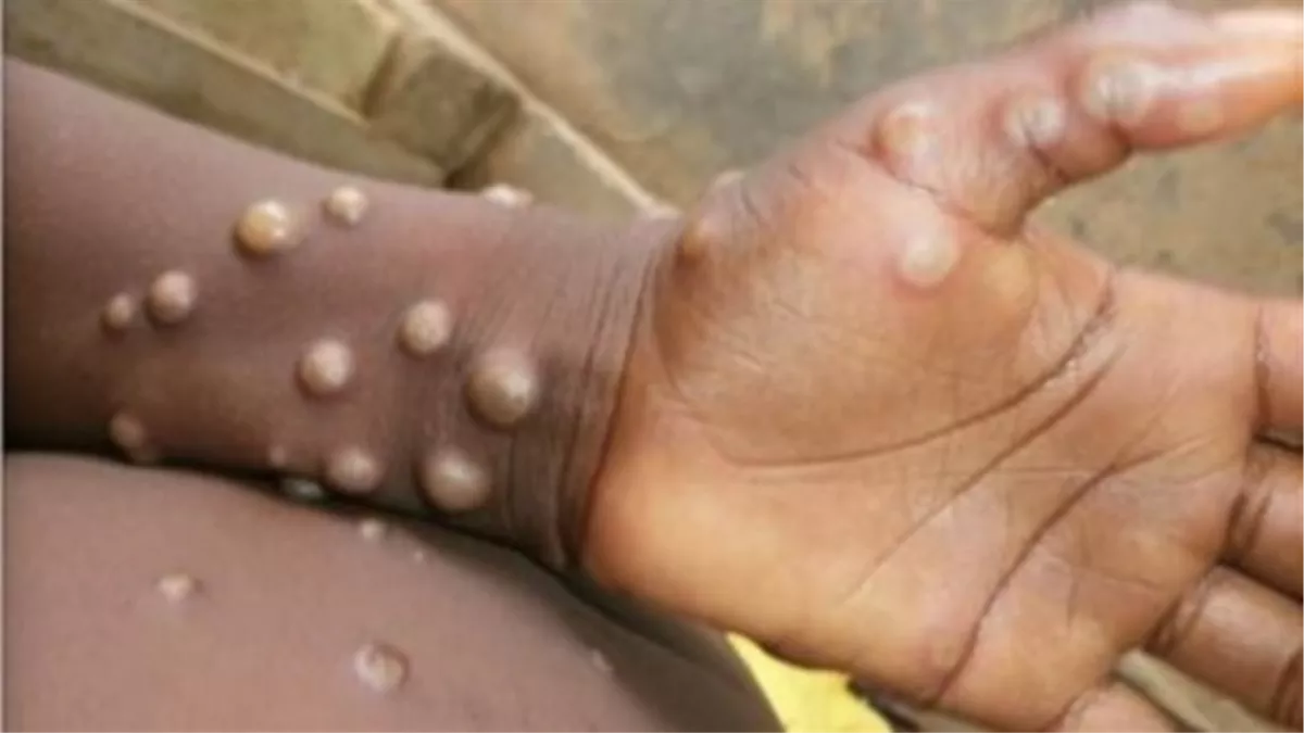 Monkeypox Virus Outbreak: लखनऊ में अब मंकी पाक्स वायरस को लेकर अलर्ट जारी, जानिए लक्षण और बचाव के उपाय