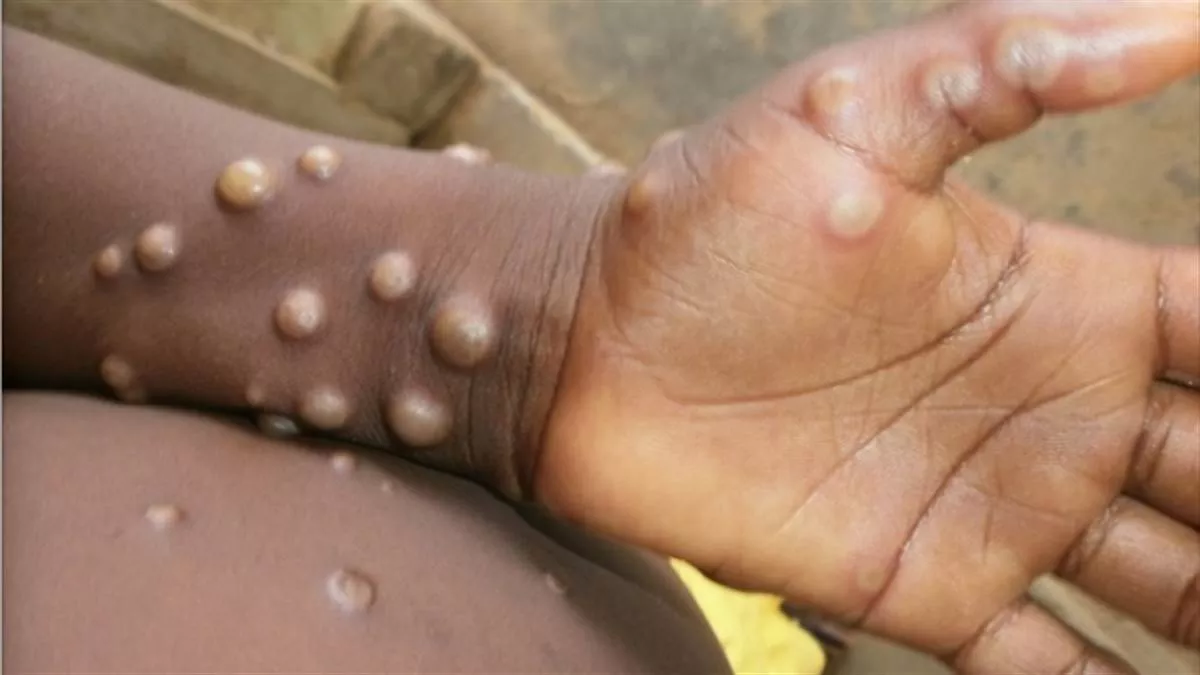 Monkeypox Virus: अमेरिका में बढ़ा मंकीपाक्स का प्रकोप, 7 राज्यों में 9 नए मामलों की हुई पुष्टि