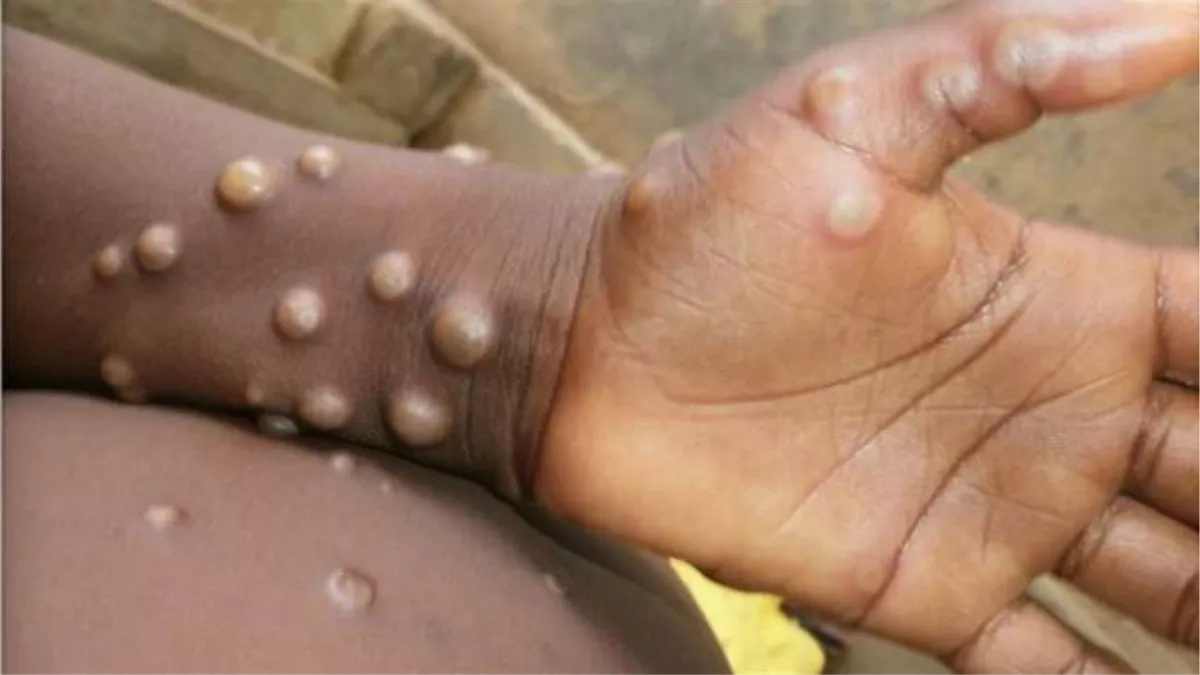 MonkeyPox Alert: जालंधर में सेहत विभाग ने जारी की एडवाइजरी, प्रभावित देशों से लौटे लोगों पर भी पैनी नजर