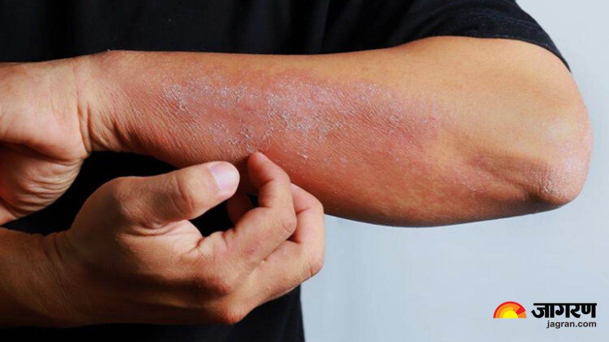https://www.jagranimages.com/images/newimg/27052024/27_05_2024-fungal_infection_home_remedies_23726364.jpg