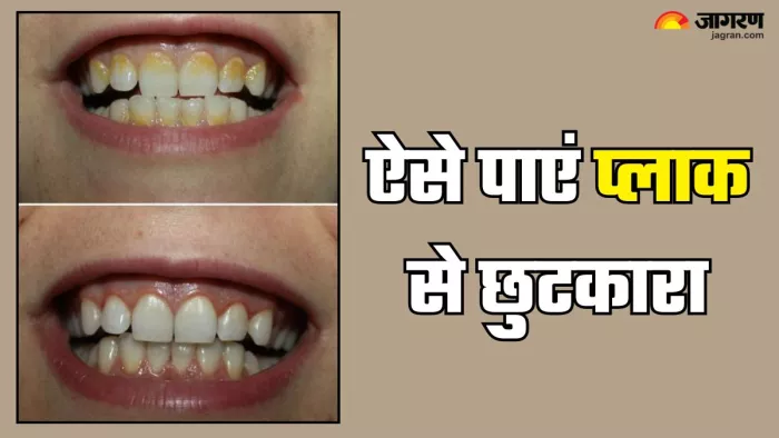 दादी-नानी के नुस्खों से पाएं दांतों के प्लाक से छुटकारा (Picture Credit- Freepik)
