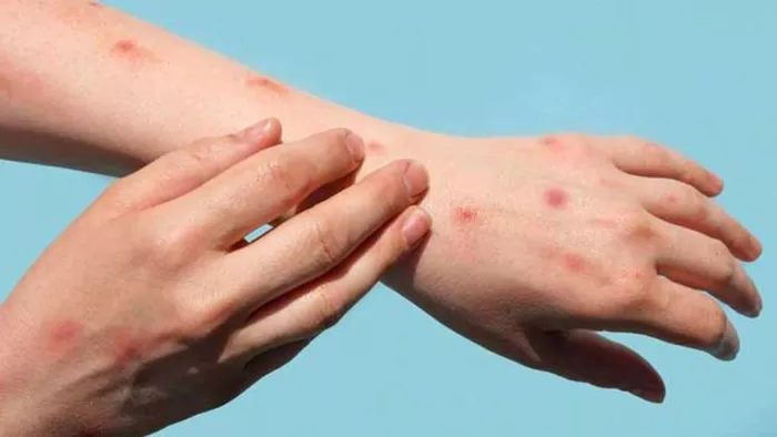 Monkeypox Case: केरल में मंकीपॉक्स का दूसरा मामला सामने आया है।(फोटो सोर्स: जागरण)