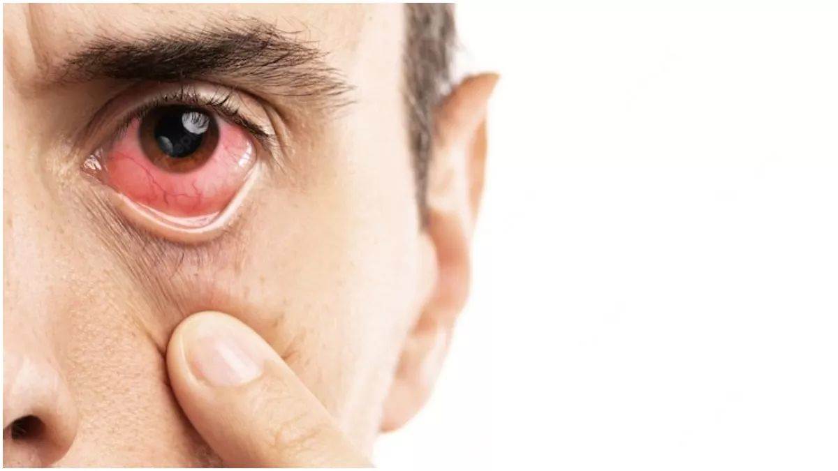 conjunctivitis outbreak in patna cases surge precautions