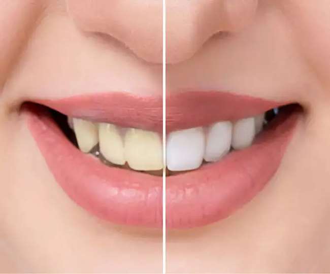 https://www.jagranimages.com/images/newimg/27122021/27_12_2021-teeth_whitening_22328132.jpg