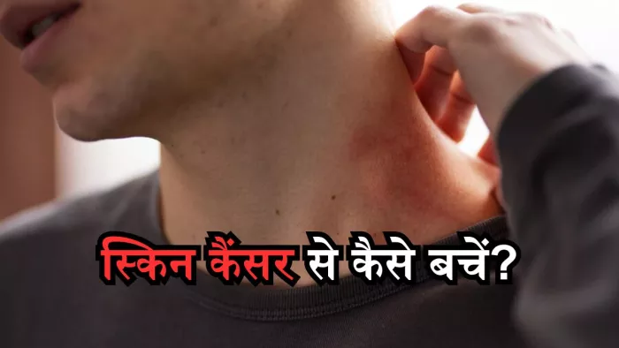 कैसे करें स्किन कैंसर की पहचान, जानिए इससे बचाव के तरीके