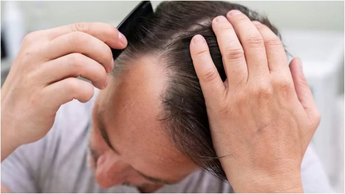 Hair Loss In Men: ये हैं पुरुषों के बाल झड़ने के पीछे के 10 कारण! - Causes Why Men Starts Losing Their Hair Hair Loss In Men: ये हैं पुरुषों के बाल झड़ने के पीछे के 10 कारण! - Causes Why Men Starts Losing Their Hair