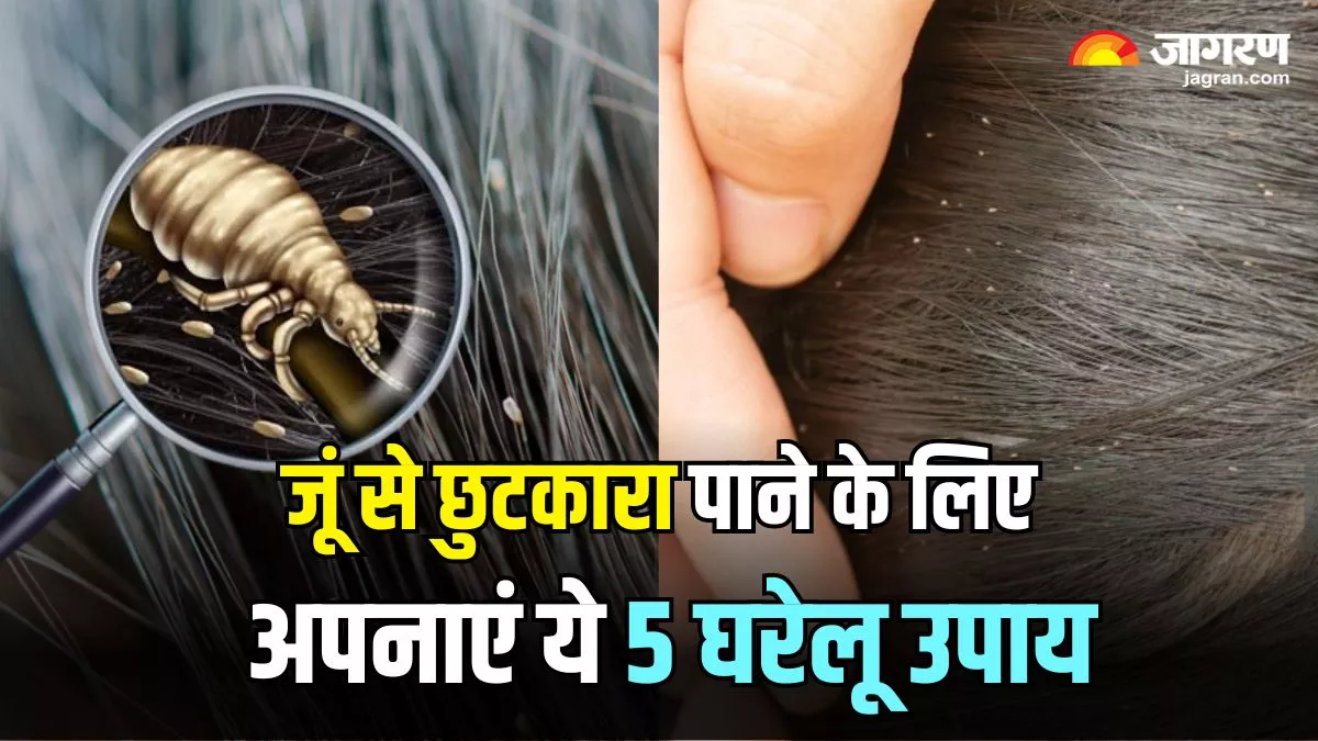 Home Remedies For Lice: सिर में हो गई है जूं और लीख, तो इन्हें जड़ से खत्म करने के लिए अपनाएं ये 5 घरेलू उपाय